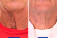 Neck cream