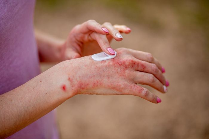 Eczema skincare routine