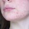 Acne-prone skin skincare