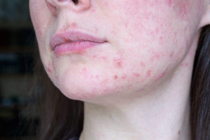 Acne-prone skin skincare