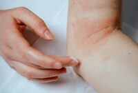 Eczema skincare routine